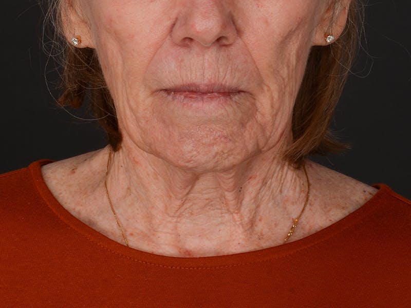 Neck Lift Before & After Gallery - Patient 361406 - Image 3