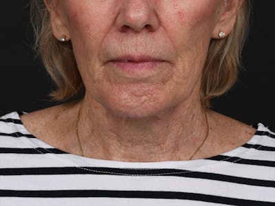 Chin Augmentation Before & After Gallery - Patient 203446 - Image 2