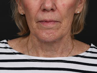 Chin Augmentation Before & After Gallery - Patient 203446 - Image 2