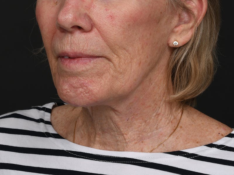 Chin Augmentation Before & After Gallery - Patient 203446 - Image 8