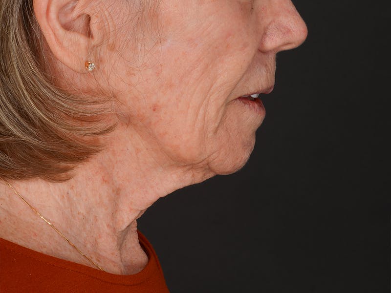 Neck Lift Before & After Gallery - Patient 361406 - Image 9