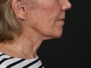 Neck Lift Before & After Gallery - Patient 361406 - Image 10