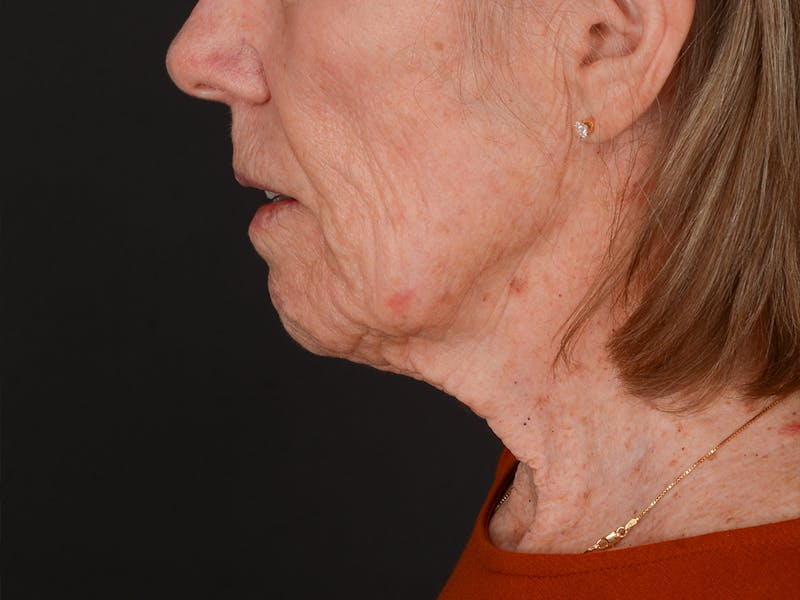 Chin Augmentation Before & After Gallery - Patient 203446 - Image 11