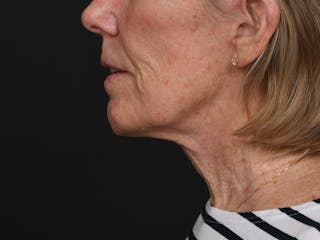 Neck Lift Before & After Gallery - Patient 361406 - Image 12