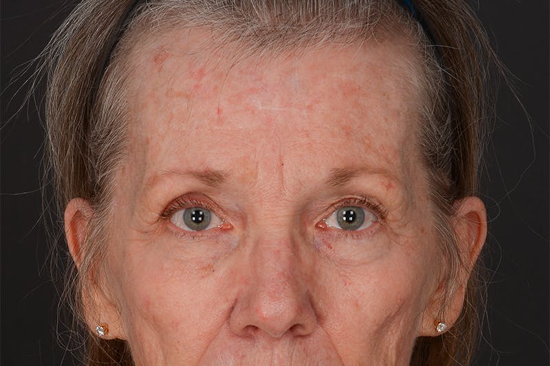 Blepharoplasty Before & After Gallery - Patient 209739 - Image 1