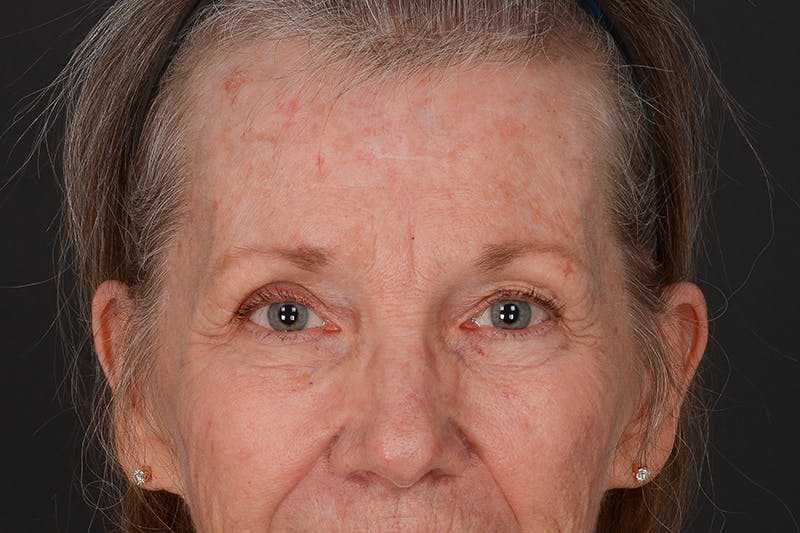 Blepharoplasty Before & After Gallery - Patient 209739 - Image 3
