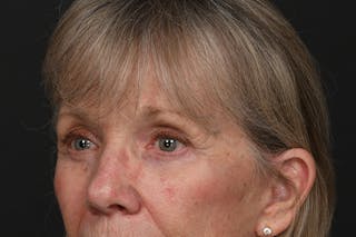 Blepharoplasty Before & After Gallery - Patient 209739 - Image 8