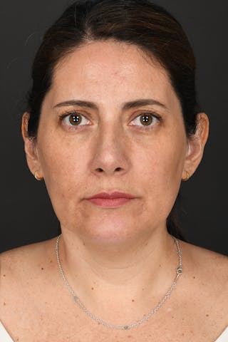 Rhinoplasty Before & After Gallery - Patient 728663 - Image 4