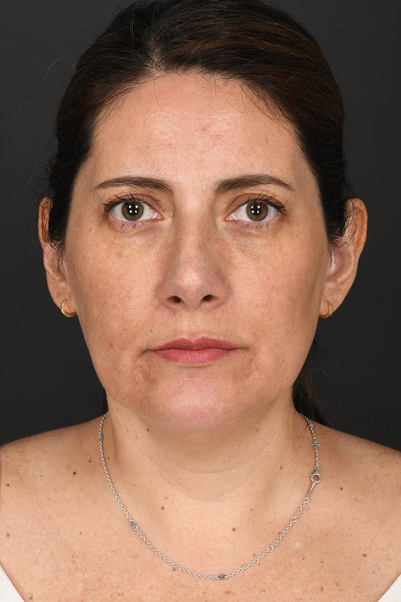 Rhinoplasty Before & After Gallery - Patient 728663 - Image 2
