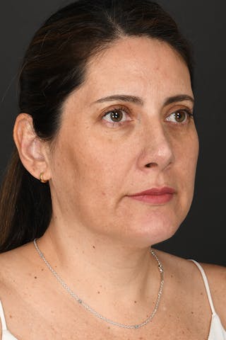Rhinoplasty Before & After Gallery - Patient 728663 - Image 8
