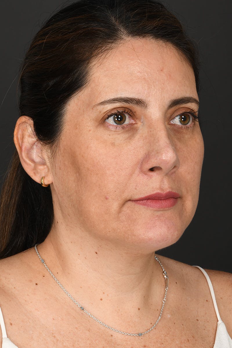 Rhinoplasty Before & After Gallery - Patient 728663 - Image 8