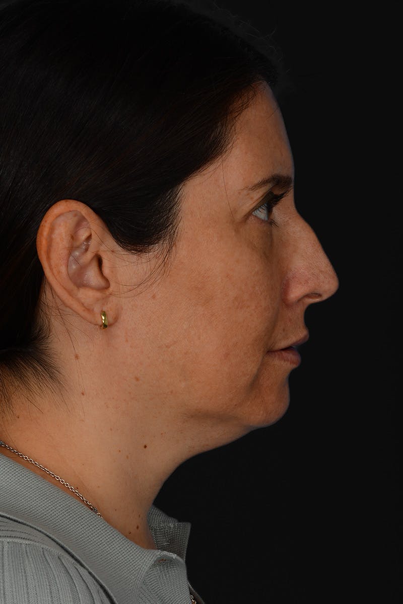 Rhinoplasty Before & After Gallery - Patient 728663 - Image 9