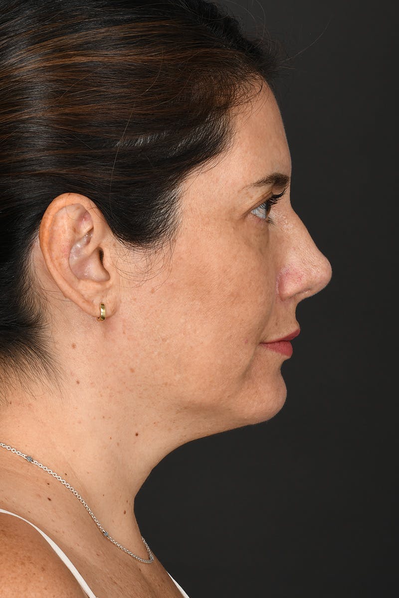 Rhinoplasty Before & After Gallery - Patient 728663 - Image 10