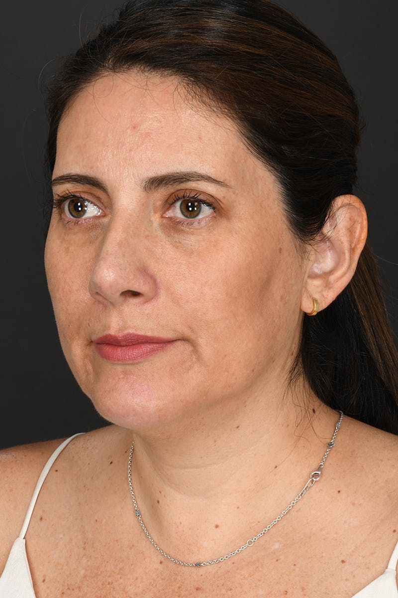 Rhinoplasty Before & After Gallery - Patient 728663 - Image 12
