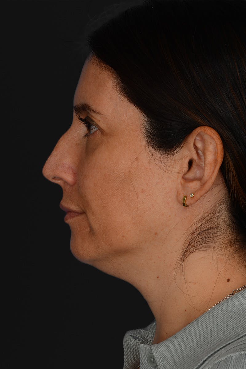 Rhinoplasty Before & After Gallery - Patient 728663 - Image 11