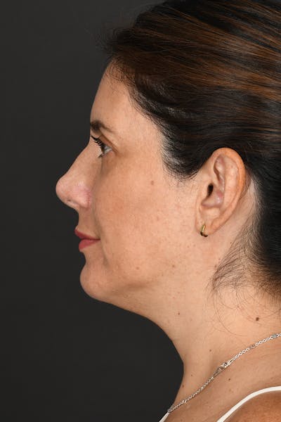 Rhinoplasty Before & After Gallery - Patient 728663 - Image 2
