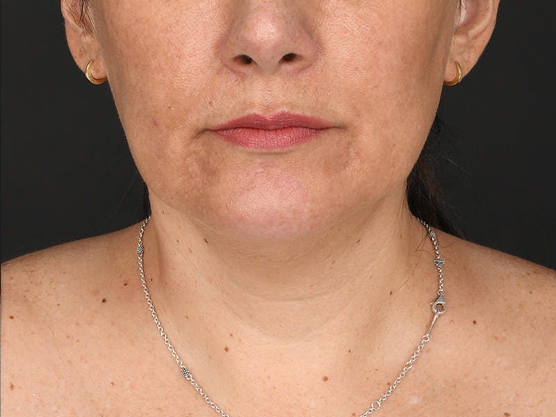 Chin Augmentation Before & After Gallery - Patient 111215 - Image 2