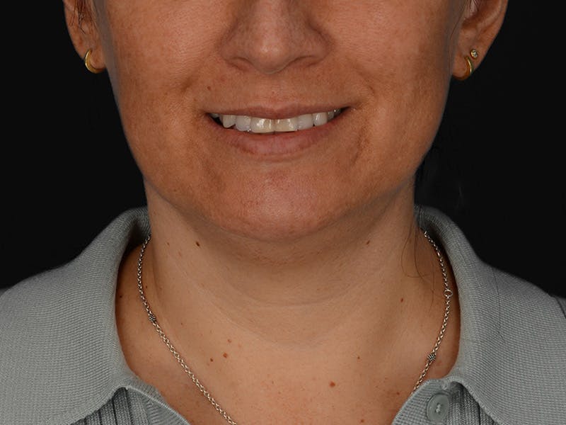 Chin Augmentation Before & After Gallery - Patient 111215 - Image 3
