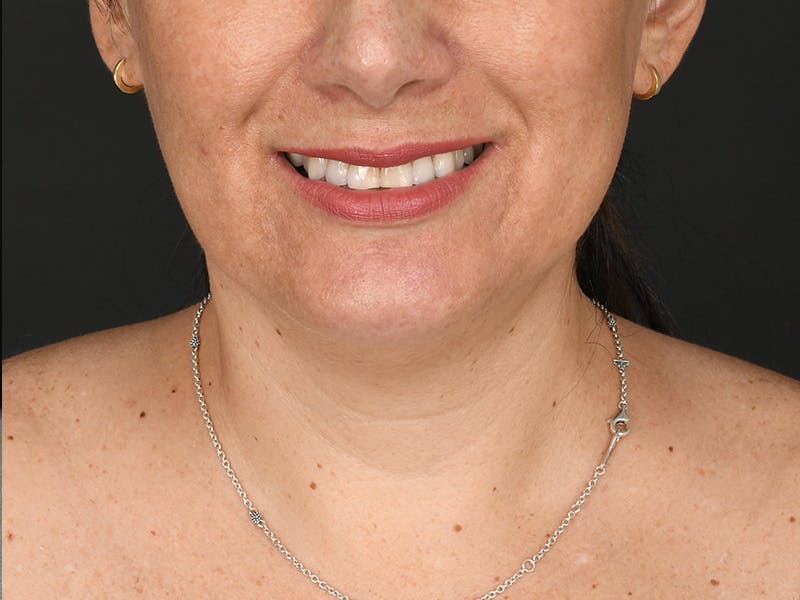 Chin Augmentation Before & After Gallery - Patient 111215 - Image 4