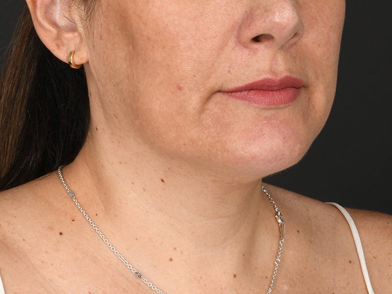 Chin Augmentation Before & After Gallery - Patient 111215 - Image 6