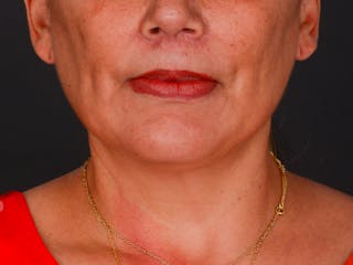 Chin Augmentation Before & After Gallery - Patient 324028 - Image 2