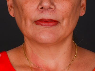 Chin Augmentation Before & After Gallery - Patient 324028 - Image 2