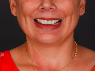 Chin Augmentation Before & After Gallery - Patient 324028 - Image 4