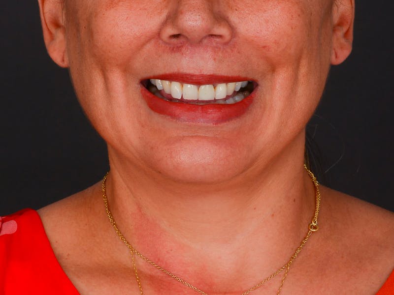 Chin Augmentation Before & After Gallery - Patient 324028 - Image 4