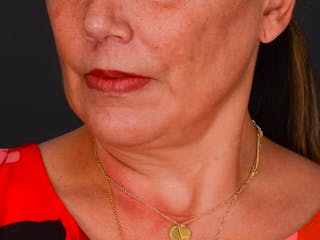 Chin Augmentation Before & After Gallery - Patient 324028 - Image 8