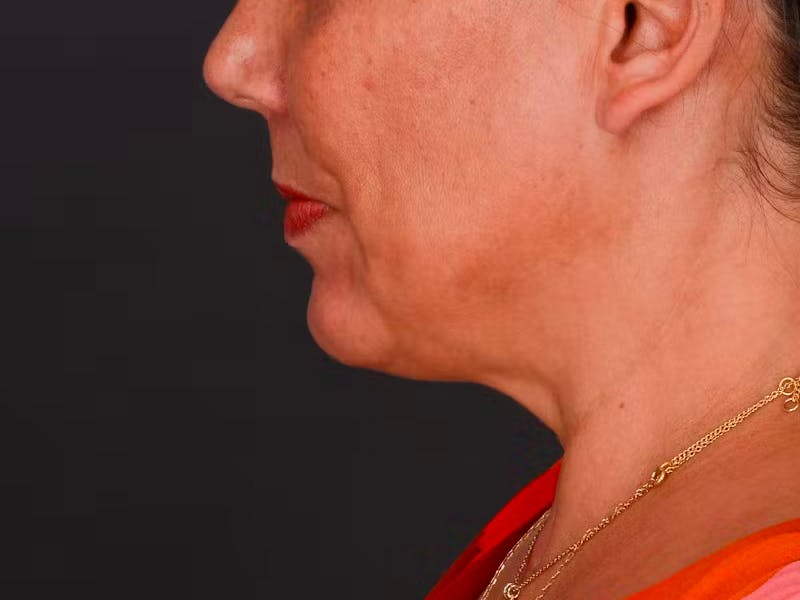 Chin Augmentation Before & After Gallery - Patient 324028 - Image 12