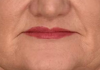 Lip Lift Before & After Gallery - Patient 225597 - Image 2