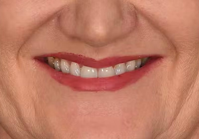 Lip Lift Before & After Gallery - Patient 225597 - Image 4
