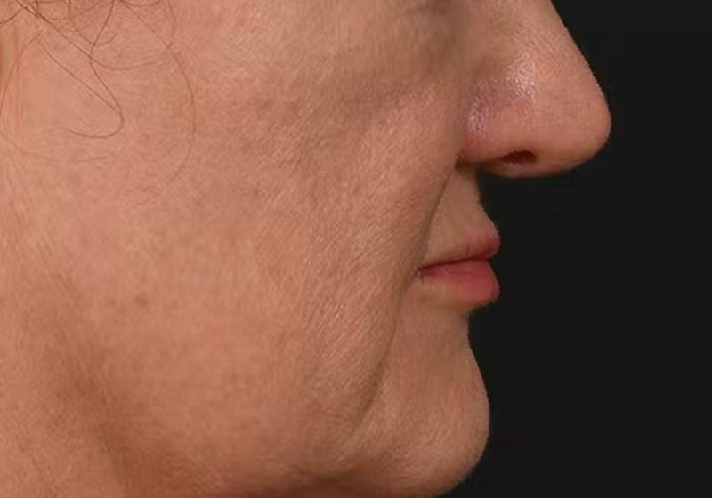 Lip Lift Before & After Gallery - Patient 225597 - Image 7