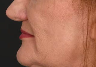 Lip Lift Before & After Gallery - Patient 225597 - Image 12