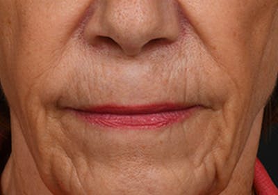Lip Lift Before & After Gallery - Patient 421909 - Image 1