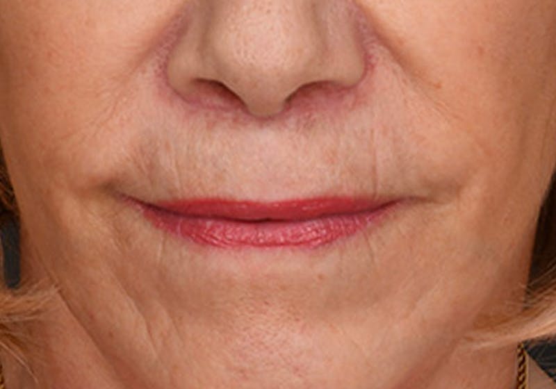 Lip Lift Before & After Gallery - Patient 421909 - Image 2