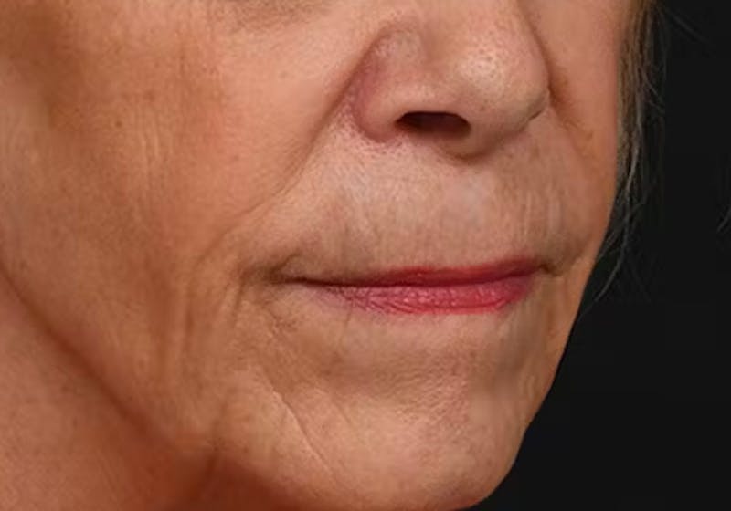 Lip Lift Before & After Gallery - Patient 421909 - Image 3