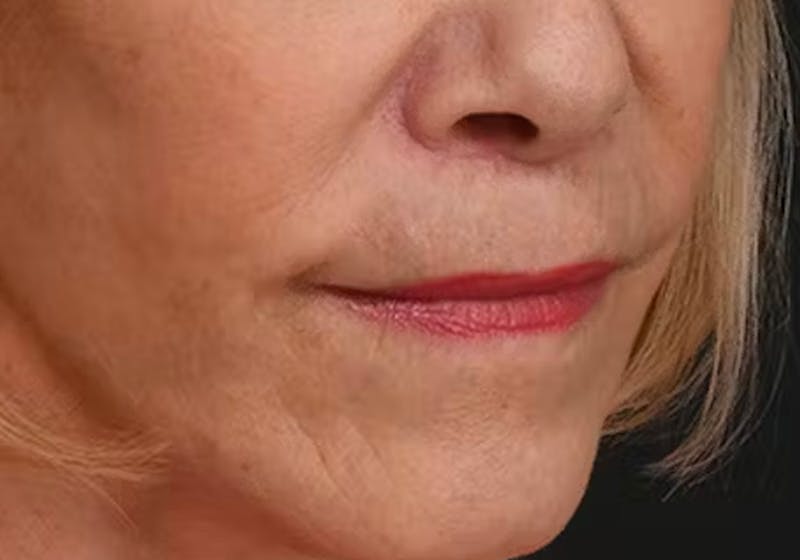 Lip Lift Before & After Gallery - Patient 421909 - Image 4