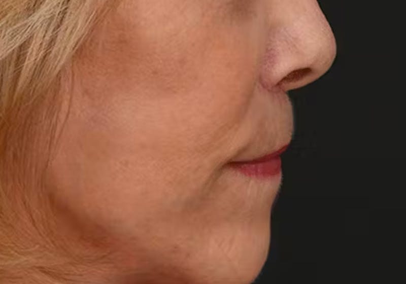 Lip Lift Before & After Gallery - Patient 421909 - Image 6