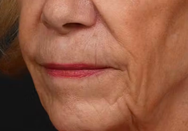 Lip Lift Before & After Gallery - Patient 421909 - Image 7