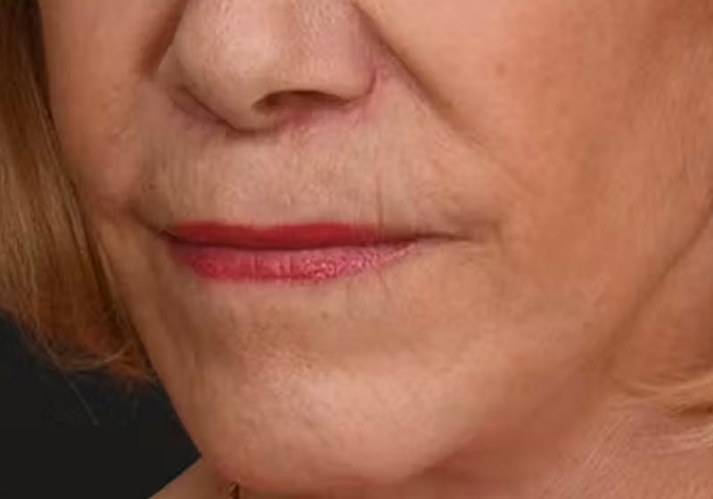 Lip Lift Before & After Gallery - Patient 421909 - Image 8