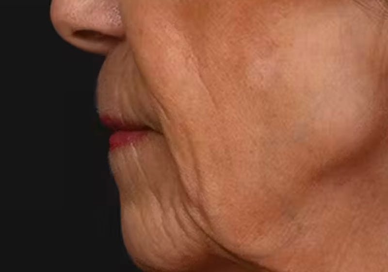 Lip Lift Before & After Gallery - Patient 421909 - Image 9