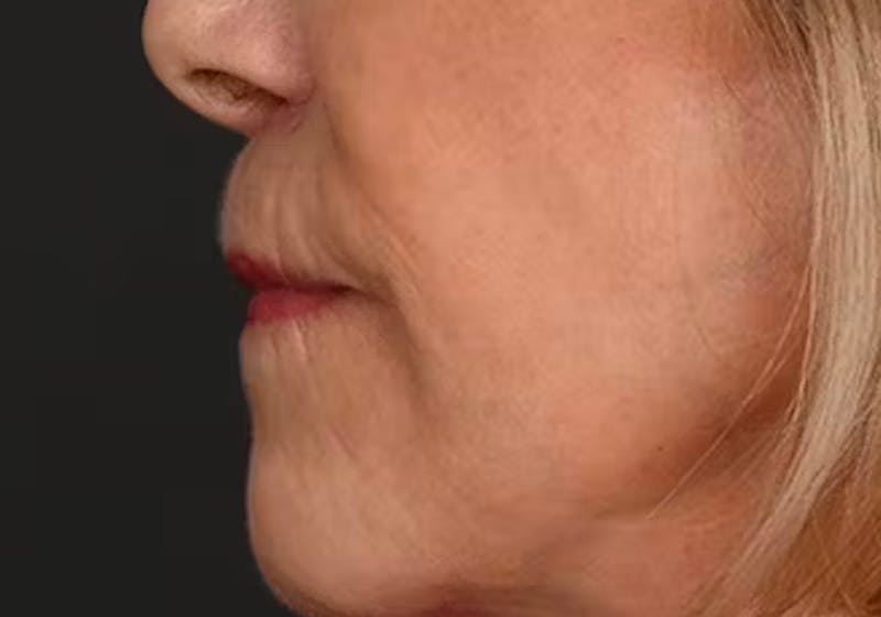 Lip Lift Before & After Gallery - Patient 421909 - Image 10