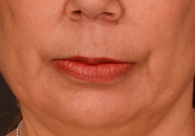 Lip Lift Before & After Gallery - Patient 364668 - Image 1