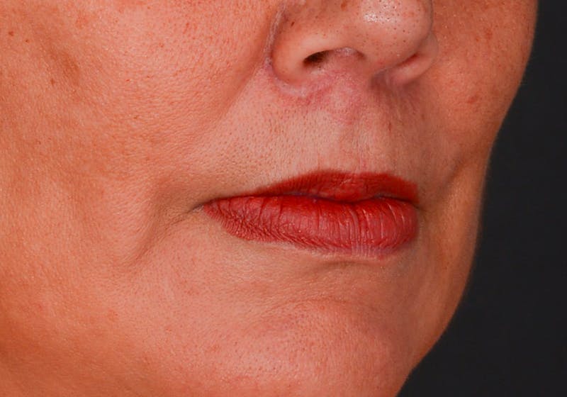 Lip Lift Before & After Gallery - Patient 364668 - Image 6