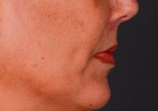 Lip Lift Before & After Gallery - Patient 364668 - Image 10