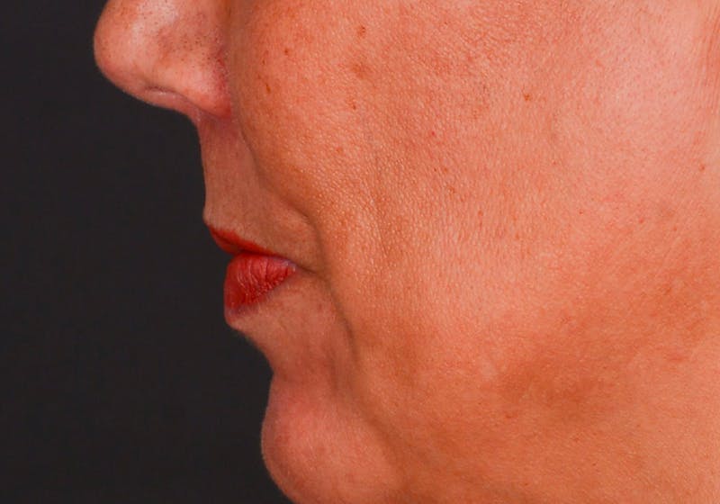 Lip Lift Before & After Gallery - Patient 364668 - Image 12