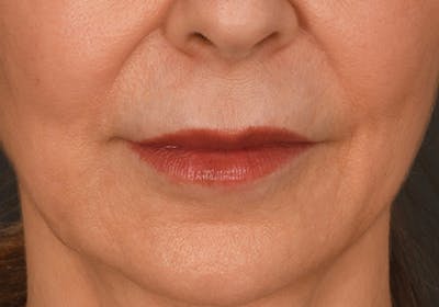 Lip Lift Before & After Gallery - Patient 155407961 - Image 1