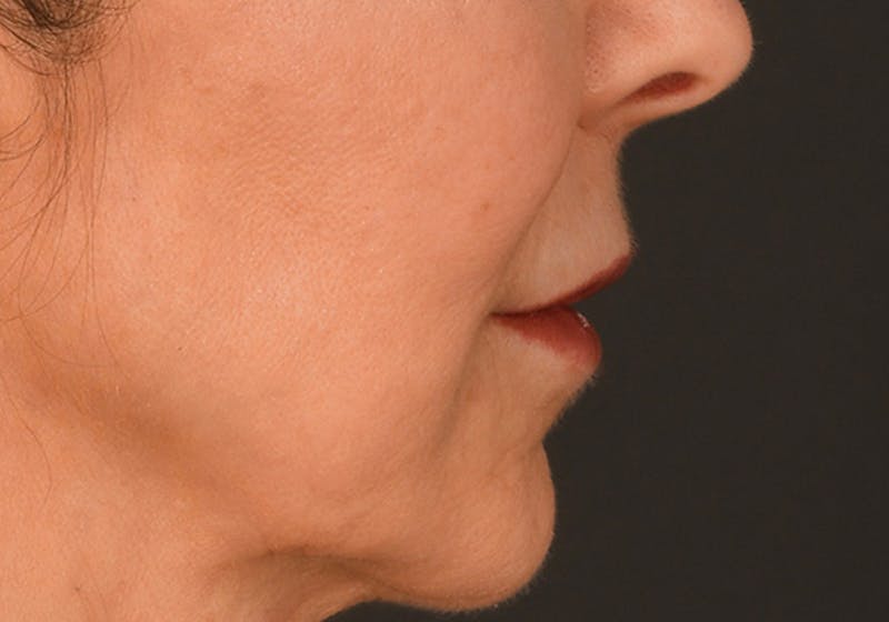 Lip Lift Before & After Gallery - Patient 155407961 - Image 5
