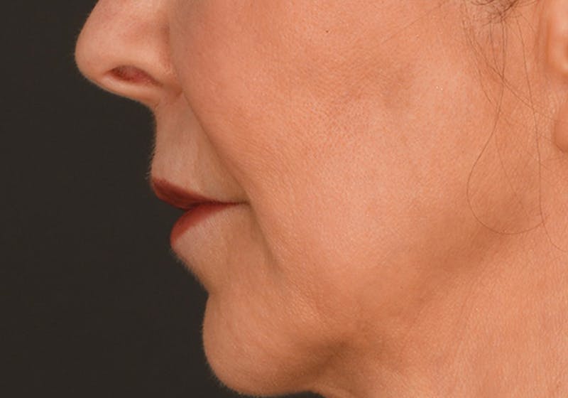 Lip Lift Before & After Gallery - Patient 155407961 - Image 9